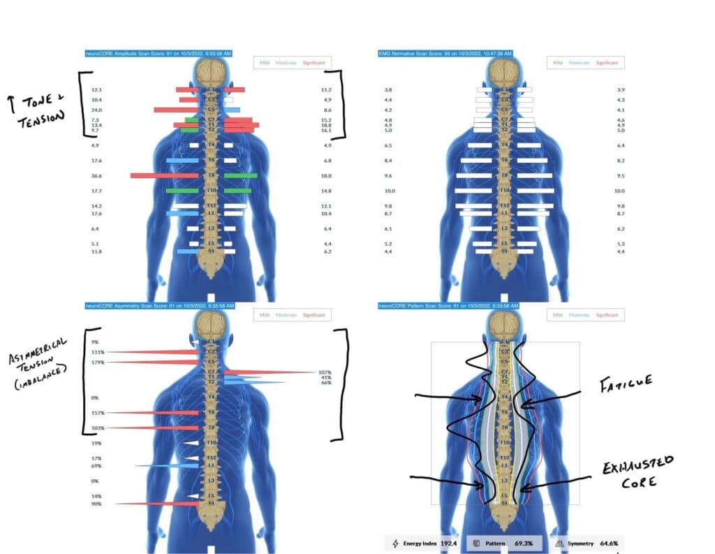 Asperger Syndrome in Children: Understanding ASD Level 1 & Chiropractic Insights 1 | PX Docs
